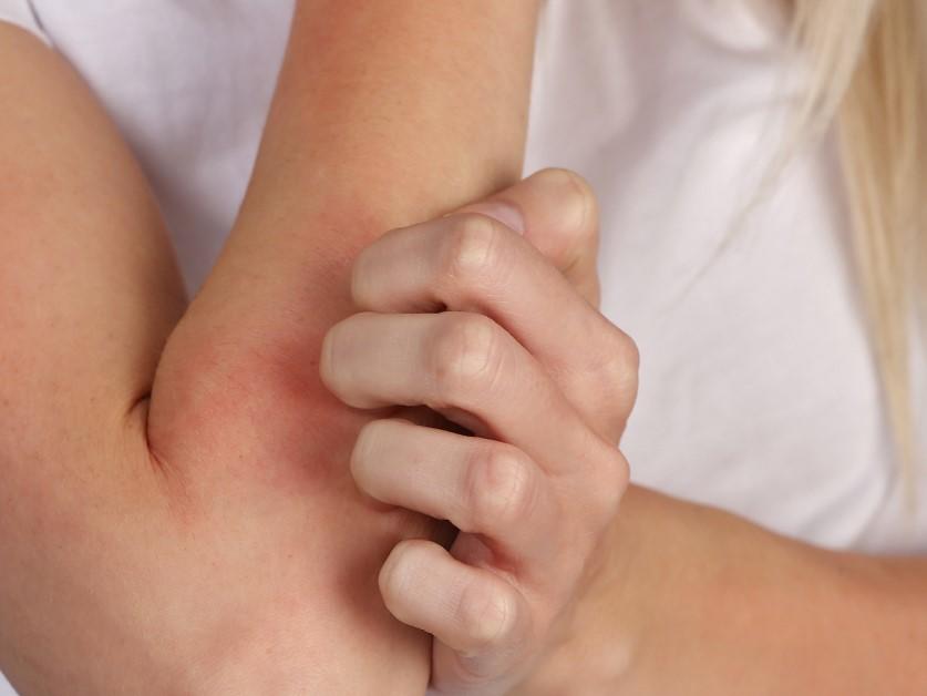 L Eczema Sur Le Visage Bepanthen Belgium L Eczema Sur Le Visage Bepanthen Belgium